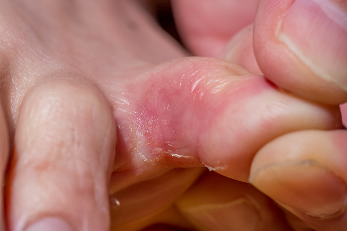 足白癬、爪白癬（みずむし）