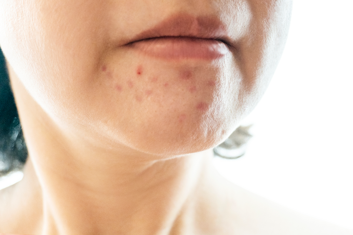 膿疱性座瘡（にきび）